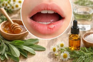 découvrez les remèdes miracles pour soulager rapidement les aphtes grâce à nos astuces efficaces et faciles à appliquer.