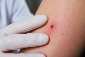 grain de beauté douloureux : découvrez quand il est important de consulter un médecin pour prévenir les risques et assurer un diagnostic rapide.